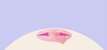 삼각피판법 2단계 — 유두 양쪽에 마젠타 삼각형으로 절개선이 표시된 유륜 일러스트