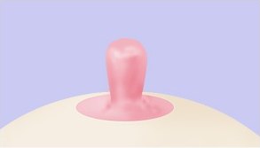수술 전 — 길게 돌출된 유두가 유방 위에 서 있는 상태를 보여주는 비유관보존법 도해