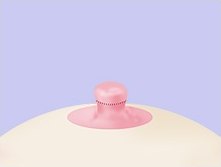 봉합을 마쳐 낮고 짧아진 유두 상단에 점선 봉합선이 둘러진 일러스트