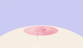 함몰유두 수술 1단계 도해 — 유두부 정면에서 본 유륜과 함몰된 유두, 절개 위치를 가리키는 점선 지시선