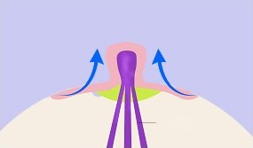 함몰유두 수술 3단계 도해 — 유두를 위로 끌어올리는 파란 곡선 화살표 두 개와 절단된 섬유조직을 나타내는 연두색 면, 보라색 유관