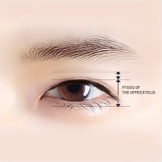 한쪽 눈 클로즈업에 눈꺼풀 처짐 정도를 재는 수평 기준선과 세로 치수 화살표가 겹쳐진 도해