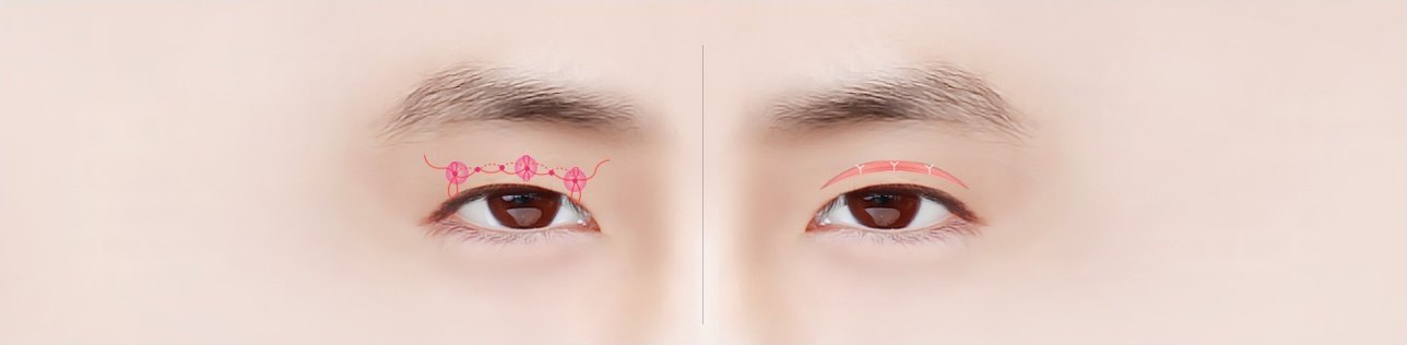 남성의 눈썹·눈 클로즈업 2컷이 좌우로 나란히 붙은 속쌍꺼풀 도해 — 왼쪽은 분홍 실 매듭, 오른쪽은 붉은 절개선 표시