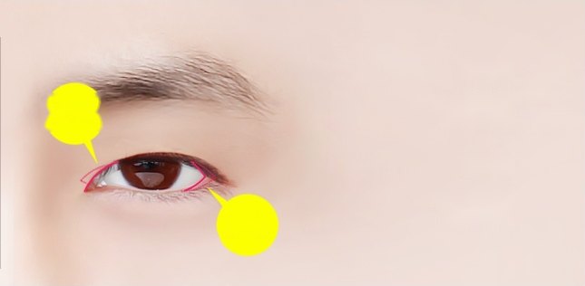 남성의 오른쪽 눈 클로즈업 — 눈 앞머리 윗쪽과 눈꼬리에 형광 분홍 표시선, 윗트임·뒤트임 위치를 가리키는 노란 지시 말풍선