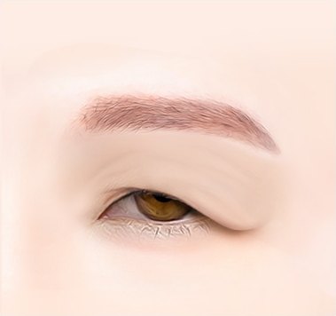 수술 전 상태의 눈 부위 일러스트 — 눈썹 아래 윗눈꺼풀 피부가 처져 주름진 모습