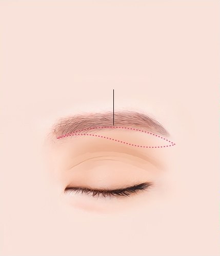 감은 눈과 눈썹을 그린 일러스트. 눈썹 아래쪽 절개 위치를 분홍 점선으로 표시