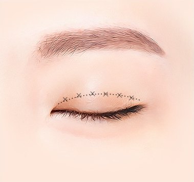 비절개 쌍꺼풀 2단계 — 눈꺼풀 디자인, 감은 눈꺼풀 위에 점선과 가위표로 쌍꺼풀 라인을 잡아 놓은 눈 도해 일러스트