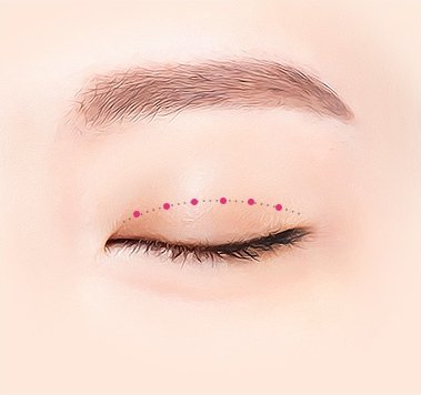 비절개 쌍꺼풀 3단계 — 6개 미세한 홈 만들기, 디자인 라인 위에 진분홍 점 여섯 개가 찍힌 눈 도해 일러스트
