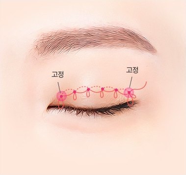 비절개 쌍꺼풀 4단계 — 가는실로 연속해서 묶어줌 (2중 고정), 눈꺼풀 주름선을 따라 가는 실이 고리를 이루며 연속으로 묶이고 양 끝 고정점에 '고정' 표시가 붙은 눈 도해 일러스트