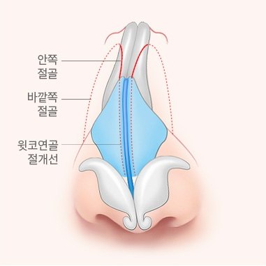 정면에서 본 코뼈 절골선과 윗코연골 절개선을 표시한 일러스트 (도해 표기: 안쪽 절골, 바깥쪽 절골, 윗코연골 절개선)