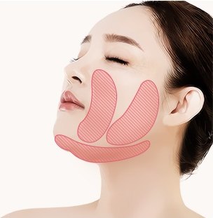 수술 전 얼굴에 지방흡입 디자인을 표시한 도해