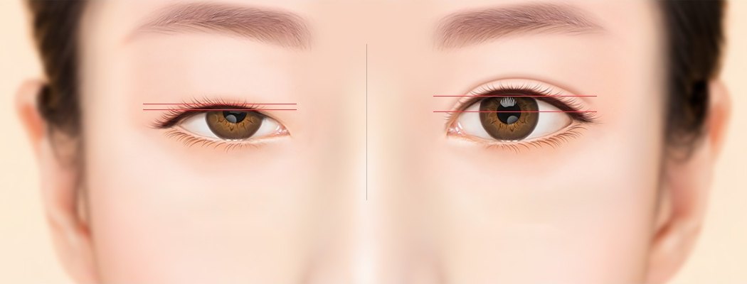 두 눈을 클로즈업한 일러스트. 왼쪽 눈은 눈꺼풀이 검은 눈동자를 2mm 지점까지 덮은 상태, 오른쪽 눈은 5mm 정도 노출된 정상 상태를 붉은 계측선으로 표시했다.
