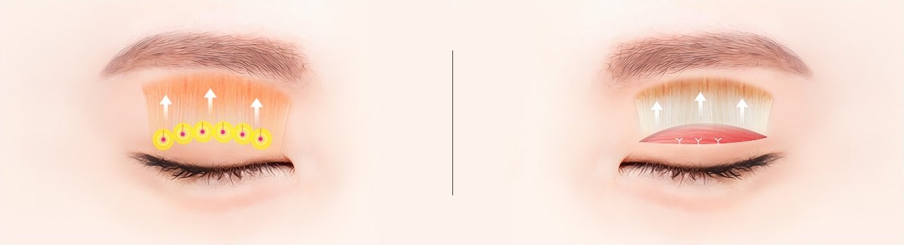 비절개 눈매교정과 절개 눈매교정의 원리를 나란히 보여주는 도해. 왼쪽은 눈꺼풀 안쪽을 실과 매듭으로 고정하는 모습, 오른쪽은 절개면을 통해 조직을 제거한 뒤 봉합하는 모습.