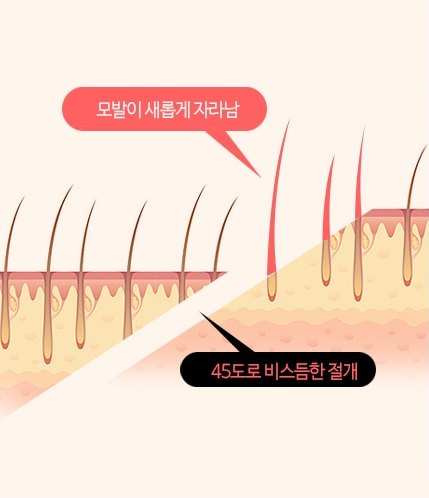 두피 단면 일러스트 — 모발이 새롭게 자라남, 45도로 비스듬한 절개