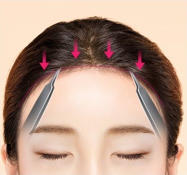 앞으로 내리고 피부 절제 — 두피를 앞으로 당겨 내리는 단계