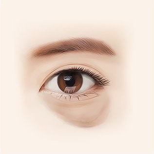50대 눈 일러스트 — 눈물고랑 피부가 어둡게 변색되고 눈 밑이 가장 심하게 처졌다