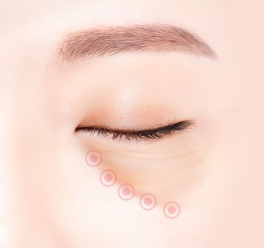 눈물 고랑 유착 제거 — 눈 밑을 따라 분홍 마커가 호를 그리며 배열된 일러스트