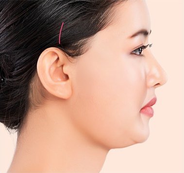 디자인 후 절개 — 측두부와 귀앞에 절개 디자인선이 표시된 프로필