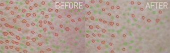 모공 측정 BEFORE / AFTER 피부 확대 비교 사진