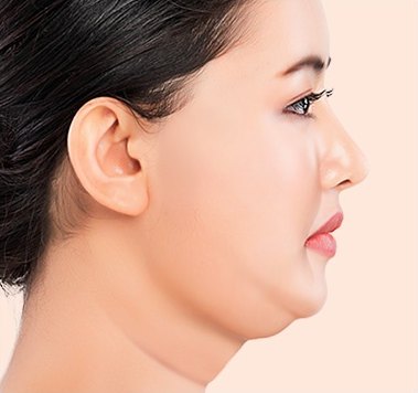 수술 전 — 얼굴과 목에 처짐이 있는 옆모습