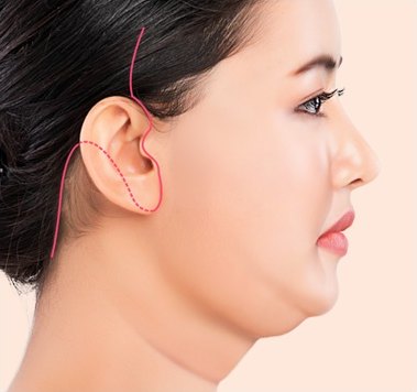 디자인 후 절개 — 귀 앞뒤로 절개 디자인선이 표시된 옆모습