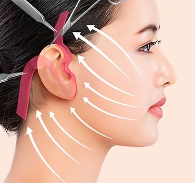 고정 및 남은 피부 절제 — 당김 방향을 나타내는 화살표가 표시된 옆모습