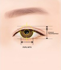 한쪽 눈 일러스트에 동공 폭(PUPIL WITH)과 윗눈꺼풀 처짐(PTOSIS OF THE UPPER EYELID)을 재는 표식이 표시된 그림