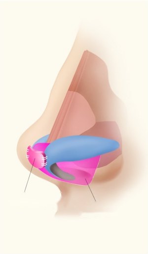 연골 이식 — 코끝 연골이식과 연골 지지대가 표시된 코 측면 단면 일러스트