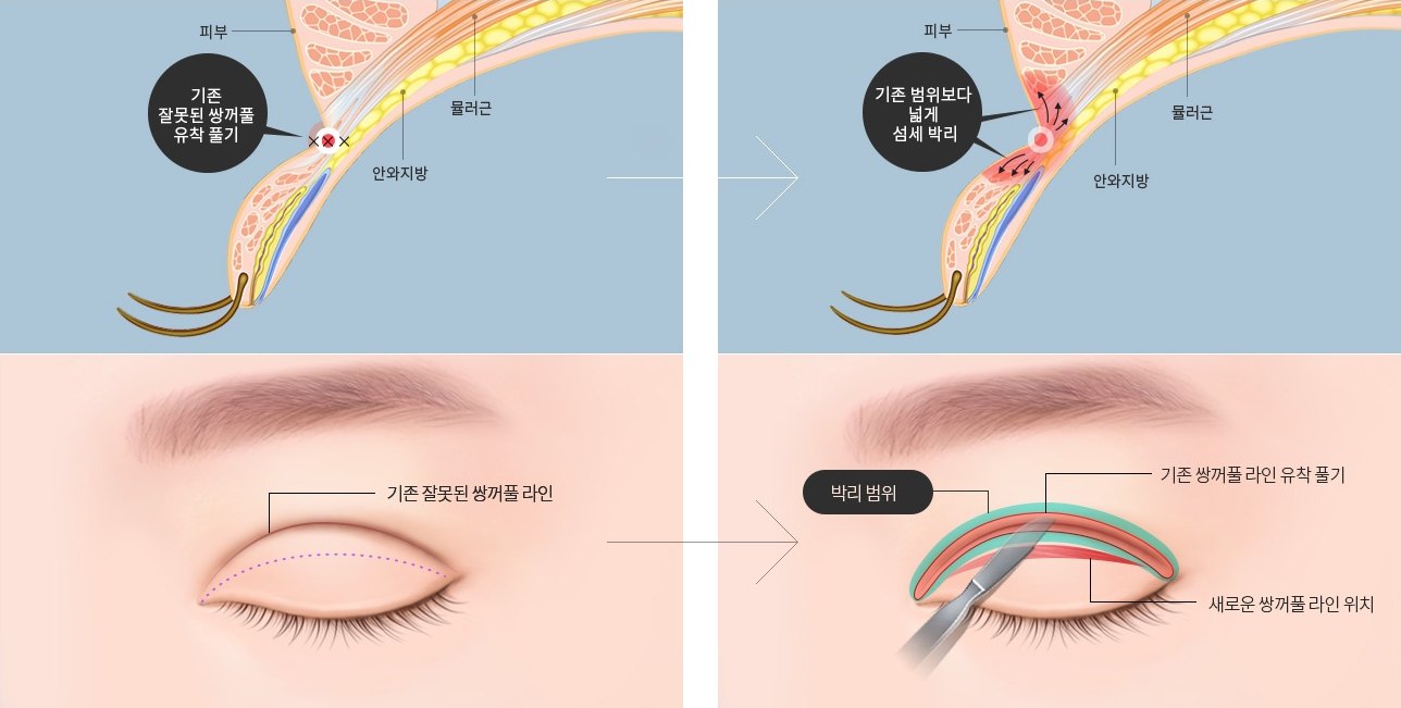 눈꺼풀 유착 박리 과정을 좌(수술 전)에서 우(수술 후)로 비교한 의학 일러스트 4컷. 위 두 컷은 눈꺼풀을 옆에서 자른 측면 단면도로 피부·근육·지방층과 유착 부위, 박리 범위를 화살표로 표시했고, 아래 두 컷은 감은 눈을 앞에서 본 정면도로 기존 라인과 새로 잡는 라인을 지시선으로 표시했다.