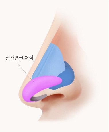 수술 전 코 측면 해부 일러스트 — 날개연골 처짐