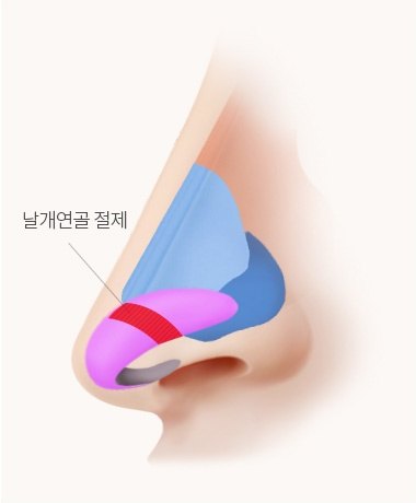 절제 단계 코 측면 해부 일러스트 — 날개연골 절제