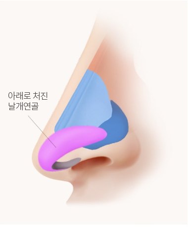 수술 전 코 측면 해부 일러스트 — 아래로 처진 날개연골
