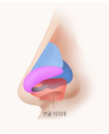 비중격연골로 만든 연골 지지대를 세운 코 측면 해부 일러스트 — 연골 지지대