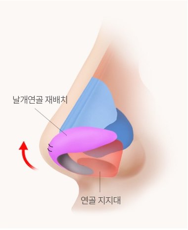 재배치 완료 코 측면 해부 일러스트 — 날개연골 재배치, 연골 지지대