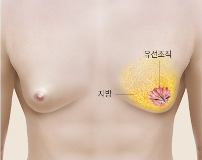 비만형 여유증 3D 의학 일러스트 — 가슴 전체가 두꺼운 지방 층으로 부풀고 붉은 유선조직은 작게 표시되어 있다