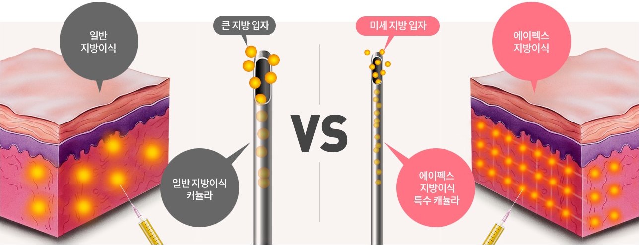 일반 지방이식과 에이펙스 지방이식 비교 인포그래픽. 왼쪽 일반 지방이식 — 큰 지방 입자, 일반 지방이식 캐뉼라. 오른쪽 에이펙스 지방이식 — 미세 지방 입자, 에이펙스 지방이식 특수 캐뉼라. 두 방식을 VS 로 대비한 피부 단면 일러스트.