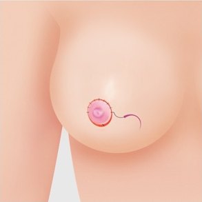 유륜 절개법 7단계 — 봉합을 마친 유륜 주위 봉합선