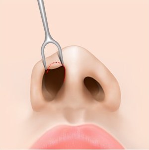 비개방형 절개 수술 1단계 — 콧구멍 안쪽 절개선을 표시한 코 단면 일러스트