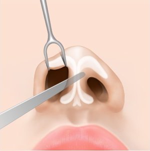 비개방형 절개 수술 2단계 — 기구로 콧망울 연골과 피부를 분리하는 일러스트