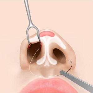 비개방형 절개 수술 4단계 — 절개 부위를 봉합하는 코 단면 일러스트