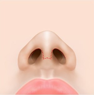 개방형 절개 수술 1단계 — 콧구멍 안쪽과 비주 부분의 절개선을 표시한 코 단면 일러스트