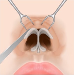 개방형 절개 수술 2단계 — 기구로 코의 피부를 들어 올려 연골과 피부를 박리하는 일러스트