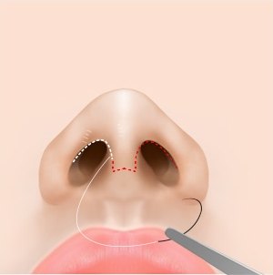 개방형 절개 수술 4단계 — 절개 부위를 봉합하는 코 단면 일러스트
