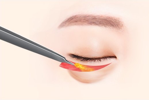 하안검 수술을 묘사한 눈 일러스트 — 은색 기구가 아래 속눈썹 라인 바로 밑을 절개해 붉은 절개면과 노란 지방을 드러낸다