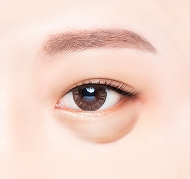수술 전 눈 밑 상태 — 눈을 뜬 눈 부위 클로즈업 일러스트, 눈 밑 지방이 불룩하게 튀어나와 있다