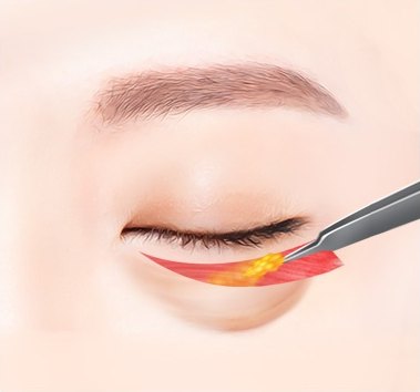 눈 밑 지방 제거 단계 — 아래 눈꺼풀이 젖혀져 붉은 근육층과 노란 지방이 드러나고 은색 겸자가 지방을 집고 있는 일러스트