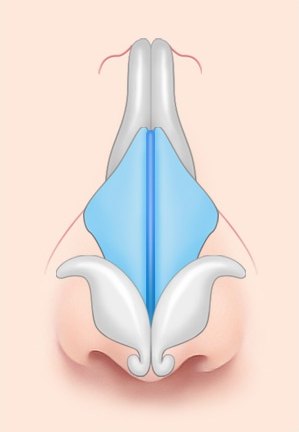 수술 후 — 연골이 모아져 코끝이 좁아진 상태의 해부 일러스트