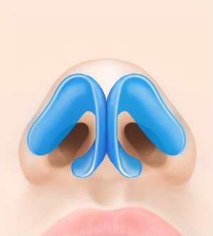 수술 전 — 파란 비익연골이 좌우로 벌어진 코의 해부 일러스트