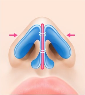 연골을 모아줌 — 분홍 화살표와 봉합사로 벌어진 연골을 묶어 모으는 일러스트