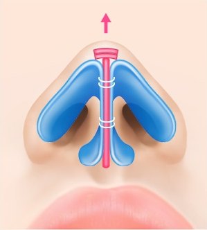 연골 삽입 — 자가조직을 추가로 삽입해 코끝이 올라간 상태의 일러스트